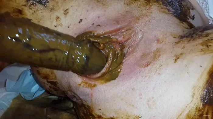 Anna Coprofield - Gynecological Self-Examination Shit - Filled Pussy Thought The Speculum [FullHD 1080p / 2.99 GB]